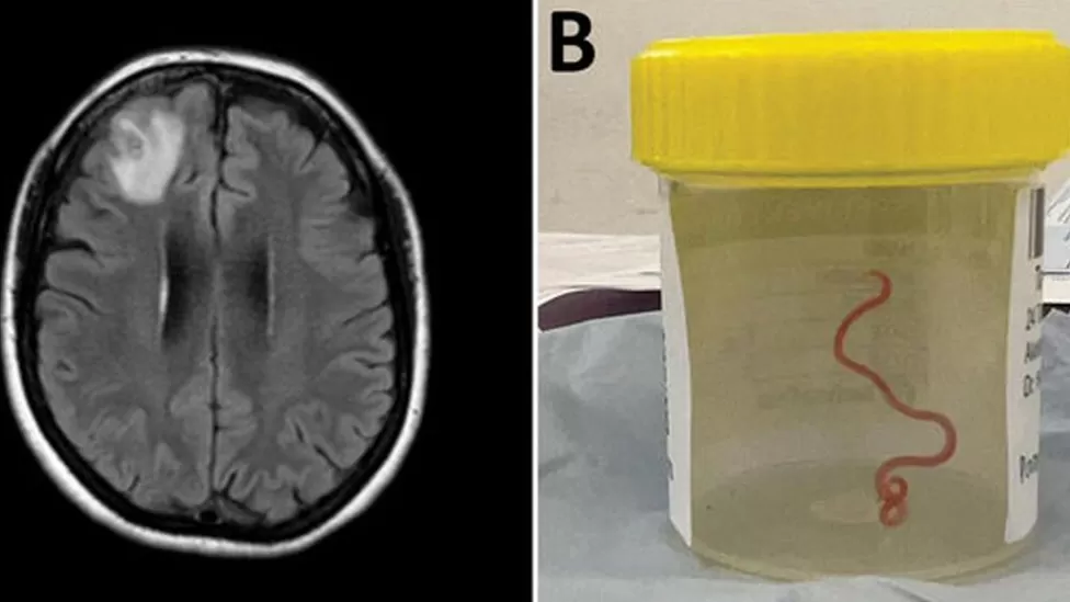 Live worm found in Australian woman’s brain in world first