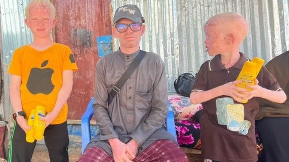 Somalis with albinism Pelted with stones and raw eggs